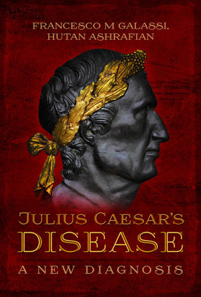 Julius Cesar’s Disease – A New Diagnosis