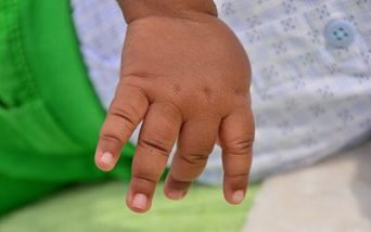 Caso di leaky SCID in un bambino proveniente da Gaza