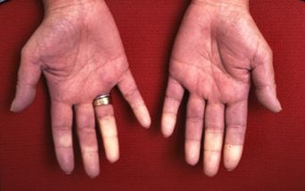 Fenomeno di Raynaud: controlli gratuiti a Bergamo