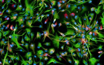 Glioma diffuso della linea mediana