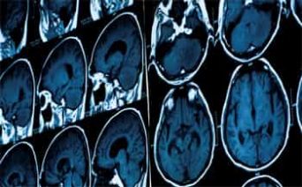 Malattie neurologiche rare, appello SIN