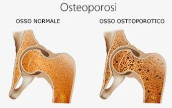 Osteoporosi