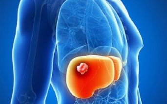Epatocarcinoma e disfunzioni metaboliche
