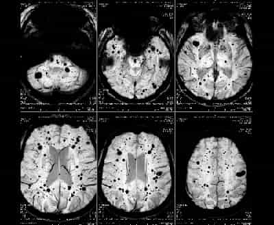 Malformazione cavernosa cerebrale