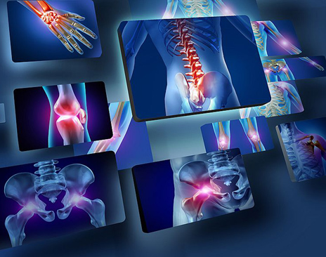 Fratture ossee - Immagine esemplificativa