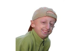 Sammy Basso progeria