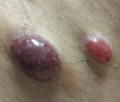 Lesioni cutanee da carcinoma a cellule di Merkel