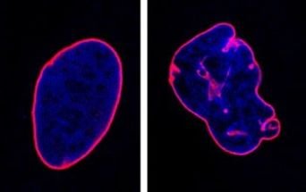 Nucleo cellulare colpito da mutazione nel gene HIST1H1E
