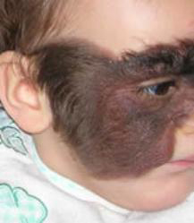 Nevo melanocitico congenito - Immagine esemplificativa (Fonte: Naevus Italia Onlus)