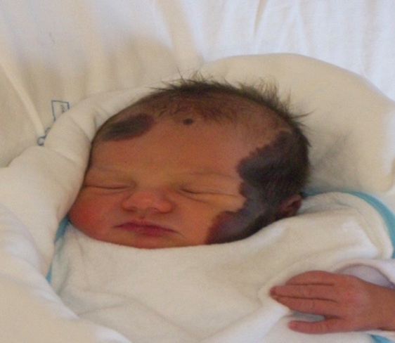 Nevo melanocitico congenito - Immagine esemplificativa (Fonte: Naevus Italia Onlus)